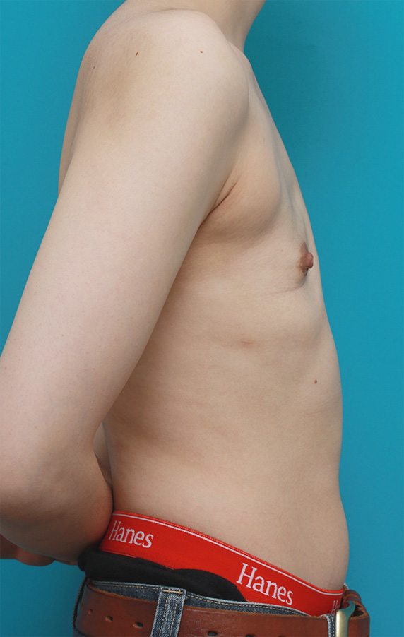 女性化乳房除去,GIDの患者様に対して、皮膚を切除せずに乳腺除去を行った症例写真,After,ba_gynecomastia_pic21_b.jpg