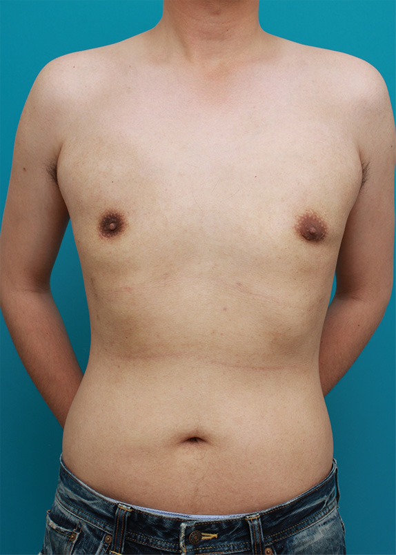 女性化乳房除去,乳腺除去と脂肪吸引を併用した女性化乳房の手術症例写真,After（3ヶ月後）,ba_gynecomastia22_b.jpg