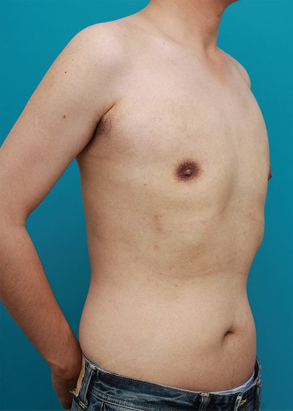 女性化乳房除去,乳腺除去と脂肪吸引を併用した女性化乳房の手術症例写真,After（3ヶ月後）,ba_gynecomastia23_b.jpg