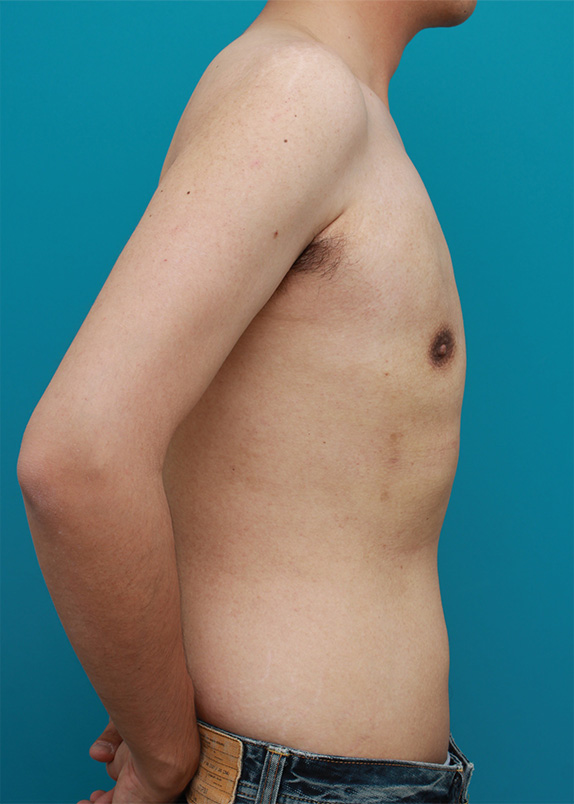 症例写真,乳腺除去と脂肪吸引を併用した女性化乳房の手術症例写真,After（3ヶ月後）,ba_gynecomastia24_b.jpg
