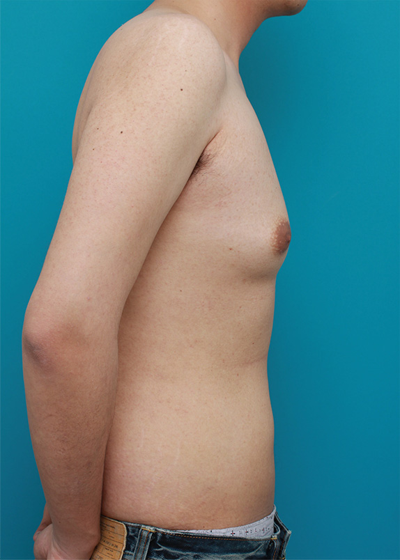女性化乳房除去,乳腺除去と脂肪吸引を併用した女性化乳房の手術症例写真,Before,ba_gynecomastia24_b.jpg