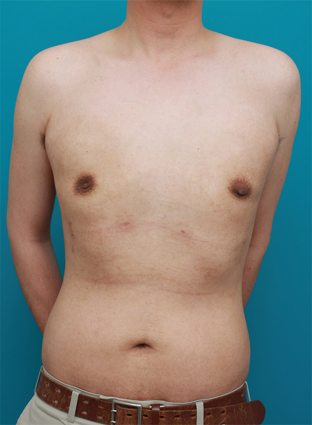 女性化乳房除去,乳腺除去と脂肪吸引を併用した女性化乳房の手術症例写真,1ヶ月後,mainpic_gynecomastia01e.jpg
