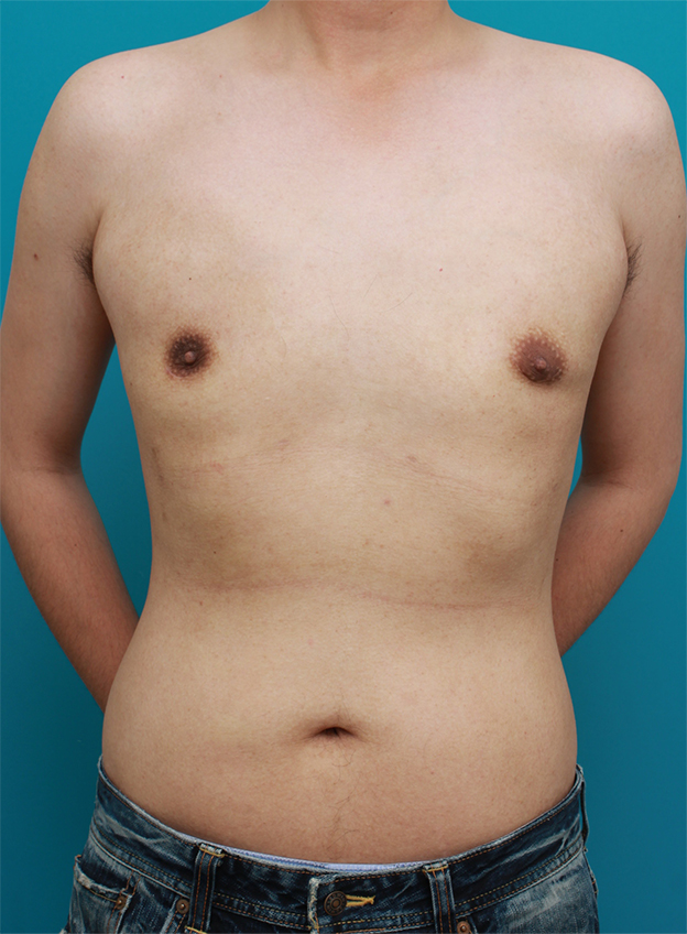 女性化乳房除去,乳腺除去と脂肪吸引を併用した女性化乳房の手術症例写真,3ヶ月後,mainpic_gynecomastia01f.jpg