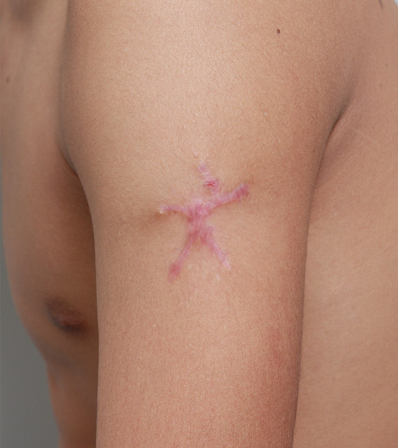 刺青（タトゥー）除去,刺青の切除縫縮手術の症例写真,After1回目手術後4ヶ月<br/>
2回目手術後1ヶ月,ba_irezumi15_b.jpg