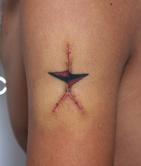 刺青（タトゥー）除去,刺青の切除縫縮手術の症例写真,1回目（施術直後）,mainpic_irezumi04b.jpg