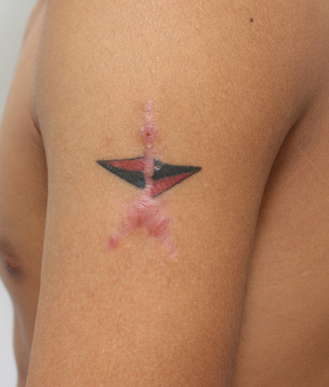 刺青（タトゥー）除去,刺青の切除縫縮手術の症例写真,1回目手術後（3ヶ月）,mainpic_irezumi04c.jpg