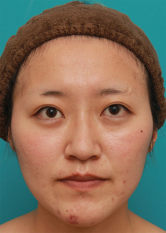 長期持続型ヒアルロン酸注射で、眉間から自然に鼻筋を通した症例写真の術前術後画像,After（1ヶ月後）,ba_ryubichusha52_a01.jpg