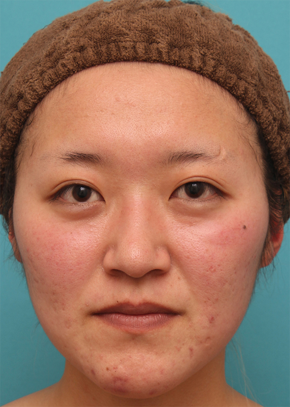 隆鼻注射（ヒアルロン酸注射）,長期持続型ヒアルロン酸注射で、眉間から自然に鼻筋を通した症例写真の術前術後画像,Before,ba_ryubichusha52_b.jpg