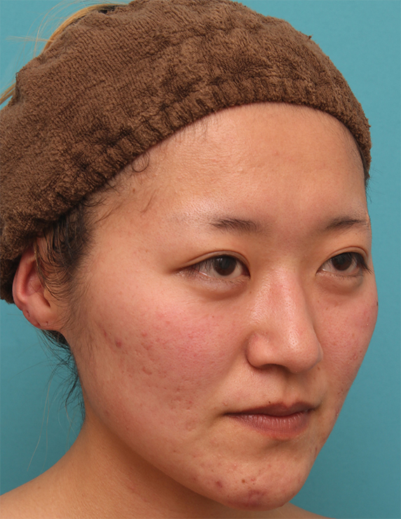 隆鼻注射（ヒアルロン酸注射）,長期持続型ヒアルロン酸注射で、眉間から自然に鼻筋を通した症例写真の術前術後画像,Before,ba_ryubichusha53_b.jpg