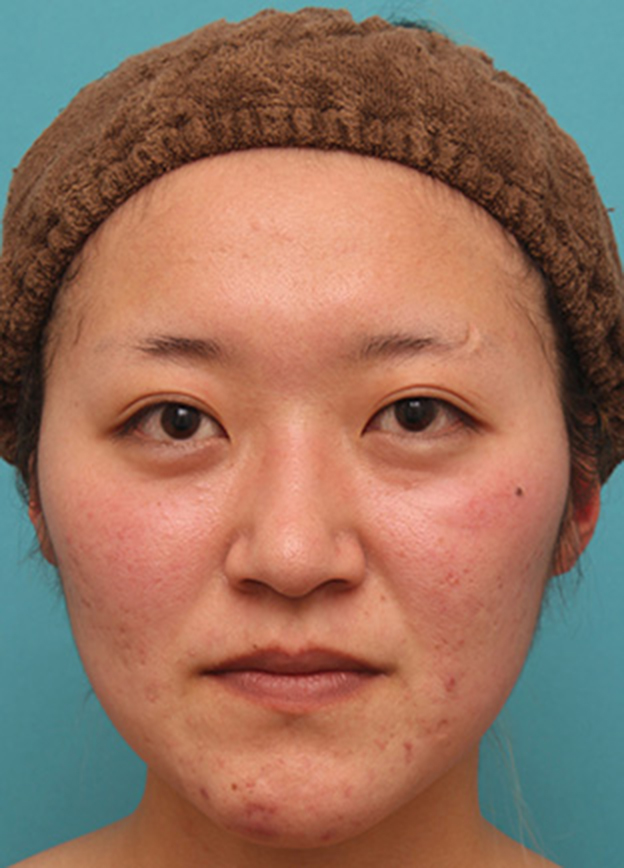 隆鼻注射（ヒアルロン酸注射）,長期持続型ヒアルロン酸注射で、眉間から自然に鼻筋を通した症例写真の術前術後画像,注射前,mainpic_ryubichusha06a.jpg