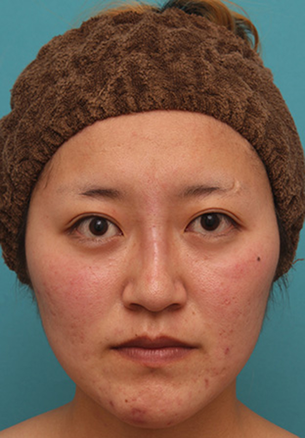 隆鼻注射（ヒアルロン酸注射）,長期持続型ヒアルロン酸注射で、眉間から自然に鼻筋を通した症例写真の術前術後画像,注射直後,mainpic_ryubichusha06b.jpg
