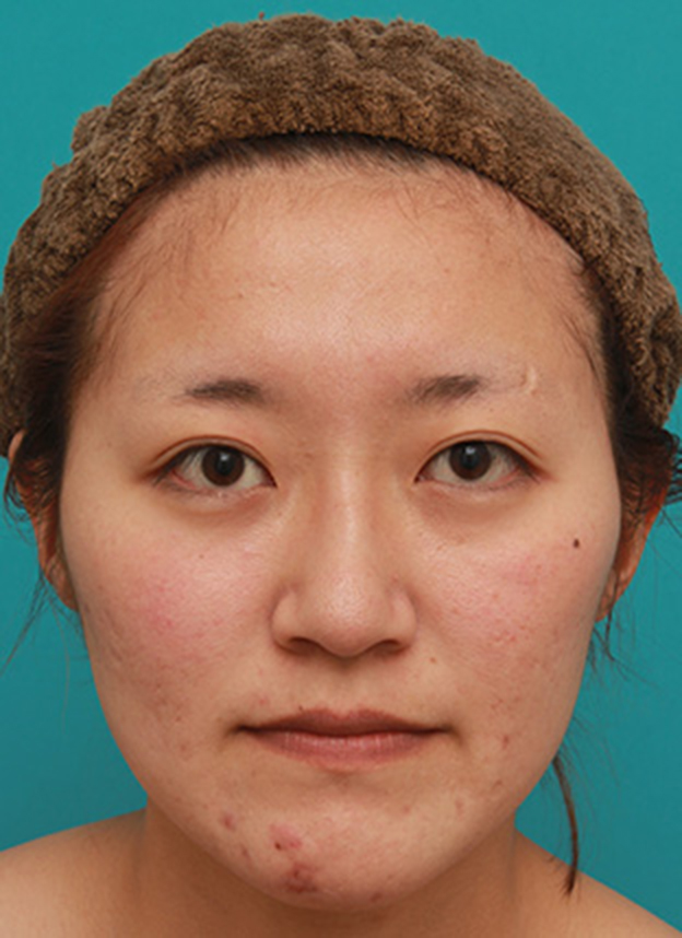 症例写真,長期持続型ヒアルロン酸注射で、眉間から自然に鼻筋を通した症例写真の術前術後画像,1週間後,mainpic_ryubichusha06c.jpg