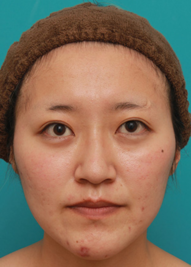 隆鼻注射（ヒアルロン酸注射）,長期持続型ヒアルロン酸注射で、眉間から自然に鼻筋を通した症例写真の術前術後画像,1ヶ月後,mainpic_ryubichusha06d.jpg