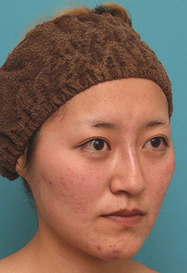 隆鼻注射（ヒアルロン酸注射）,長期持続型ヒアルロン酸注射で、眉間から自然に鼻筋を通した症例写真の術前術後画像,注射直後,mainpic_ryubichusha06g.jpg