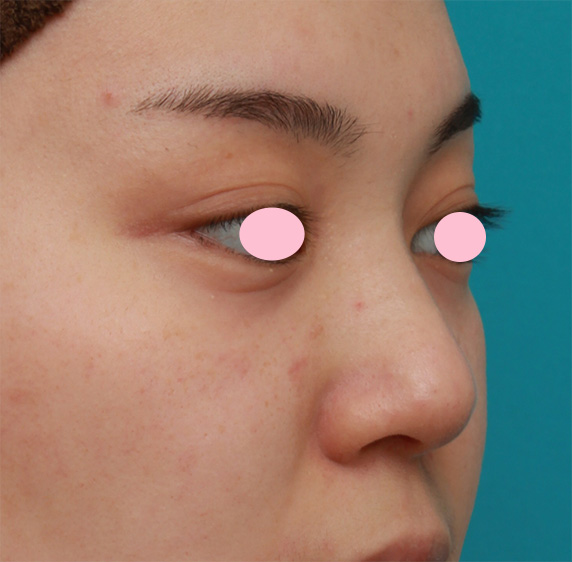 耳介軟骨移植（鼻先を出す）,団子鼻に対して鼻尖縮小はせず耳介軟骨移植のみを行った症例写真の術前術後画像,Before,ba_jikai46_b.jpg