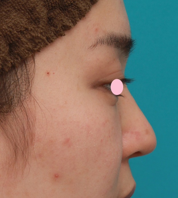 症例写真,団子鼻に対して鼻尖縮小はせず耳介軟骨移植のみを行った症例写真の術前術後画像,4ヶ月後,mainpic_jikai08l.jpg