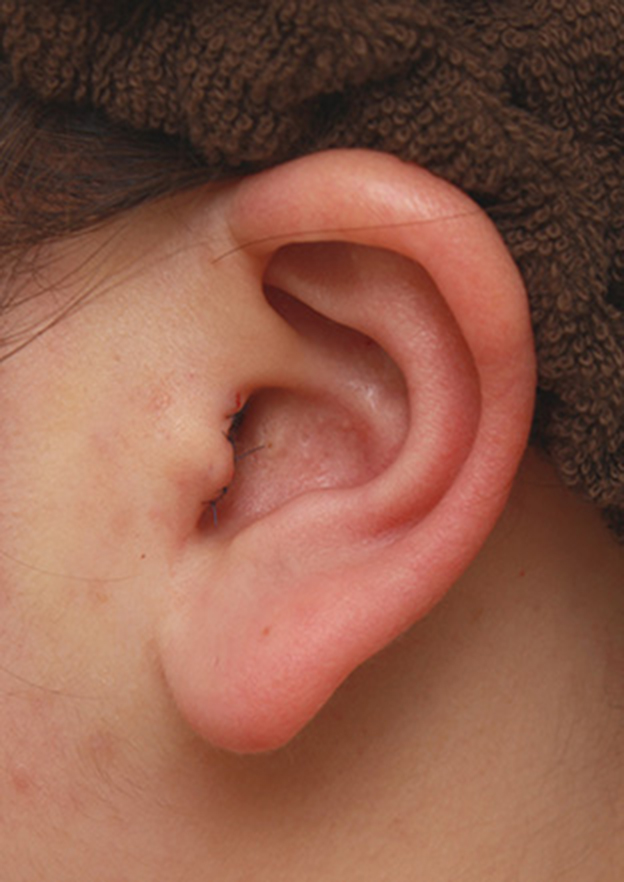 症例写真,団子鼻に対して鼻尖縮小はせず耳介軟骨移植のみを行った症例写真の術前術後画像,手術直後,mainpic_jikai08n.jpg