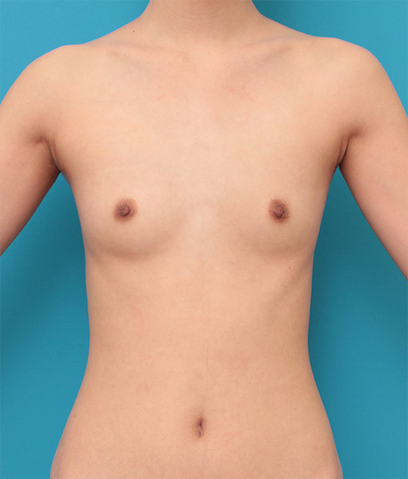 豊胸手術（シリコンプロテーゼ）,豊胸手術を行いバランスのとれた自然な美乳を作った症例写真　左右140ccずつ,Before,ba_hokyo70_b.jpg