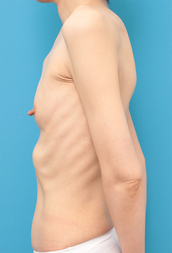 豊胸手術（シリコンプロテーゼ）,大胸筋下に125ccのシリコンプロテーゼを入れて豊胸した症例写真,Before,ba_hokyo77_b.jpg