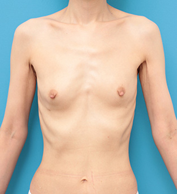 豊胸手術（シリコンプロテーゼ）,大胸筋下に125ccのシリコンプロテーゼを入れて豊胸した症例写真,手術前,mainpic_hokyo05a.jpg