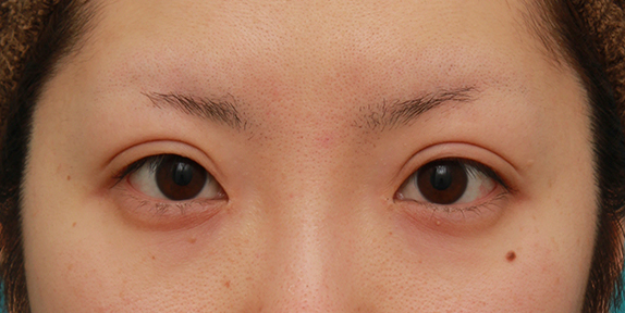眼瞼下垂（がんけんかすい）,目頭切開+眼瞼下垂手術で、アイラインを引いても奥二重のようにならない幅のある平行型二重を作った症例写真の術前術後画像,After（目を開けた状態）,ba_megashira35_b.jpg