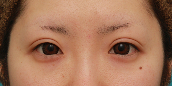眼瞼下垂（がんけんかすい）,目頭切開+眼瞼下垂手術で、アイラインを引いても奥二重のようにならない幅のある平行型二重を作った症例写真の術前術後画像,After（カラコンあり）,