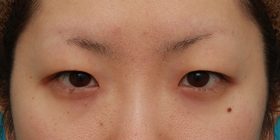 眼瞼下垂（がんけんかすい）,目頭切開+眼瞼下垂手術で、アイラインを引いても奥二重のようにならない幅のある平行型二重を作った症例写真の術前術後画像,Before,ba_megashira35_b.jpg