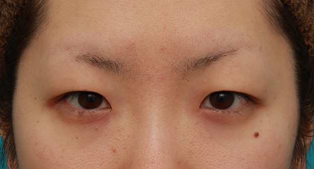 目頭切開,目頭切開+眼瞼下垂手術で、アイラインを引いても奥二重のようにならない幅のある平行型二重を作った症例写真の術前術後画像,手術前,mainpic_megashira34a.jpg
