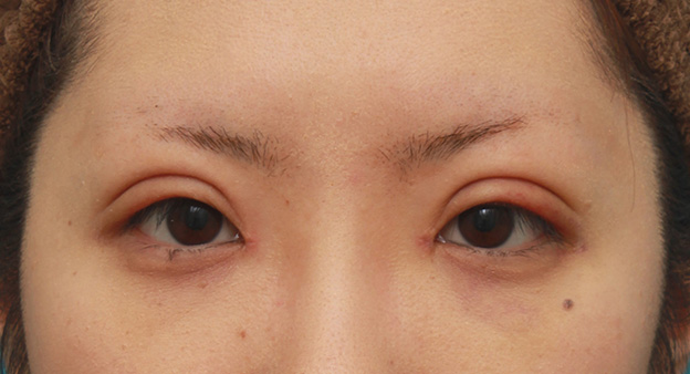 眼瞼下垂（がんけんかすい）,目頭切開+眼瞼下垂手術で、アイラインを引いても奥二重のようにならない幅のある平行型二重を作った症例写真の術前術後画像,1週間後,mainpic_megashira34c.jpg