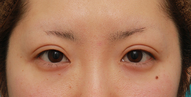 目頭切開,目頭切開+眼瞼下垂手術で、アイラインを引いても奥二重のようにならない幅のある平行型二重を作った症例写真の術前術後画像,3ヶ月後,mainpic_megashira34e.jpg