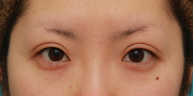 眼瞼下垂（がんけんかすい）,目頭切開+眼瞼下垂手術で、アイラインを引いても奥二重のようにならない幅のある平行型二重を作った症例写真の術前術後画像,6ヶ月後,メイクなし,mainpic_megashira34f.jpg