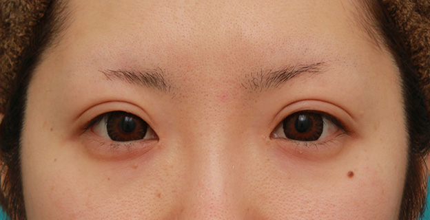 眼瞼下垂（がんけんかすい）,目頭切開+眼瞼下垂手術で、アイラインを引いても奥二重のようにならない幅のある平行型二重を作った症例写真の術前術後画像,6ヶ月後,カラコンあり,mainpic_megashira34g.jpg