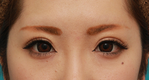 眼瞼下垂（がんけんかすい）,目頭切開+眼瞼下垂手術で、アイラインを引いても奥二重のようにならない幅のある平行型二重を作った症例写真の術前術後画像,6ヶ月後,メイクあり,mainpic_megashira34h.jpg
