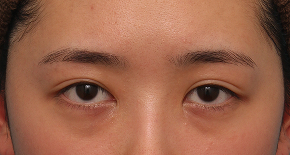 他院で受けた手術の修正（二重まぶた・目もと）,他院で目頭切開をした後、片目だけ逆Z法で蒙古襞形成し、左右対称に近づけた症例写真の術前術後画像,Before,ba_hida07_b.jpg