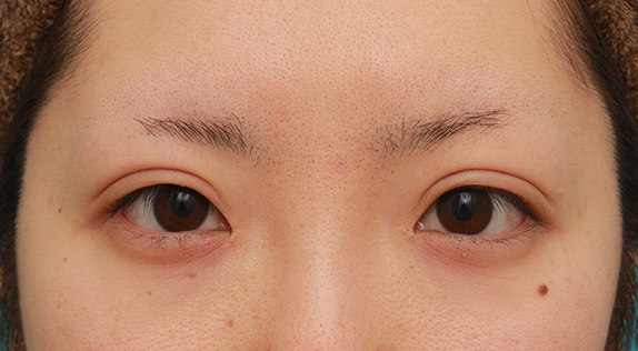 ボツリヌストキシン注射（目を下に大きくする、垂れ目形成）,ボツリヌストキシン注射（目を下に大きくする、垂れ目形成）でグラマラスラインを作り、目を大きくした症例写真の術前術後画像,After（1週間後）,ba_panda_botox03_a01.jpg