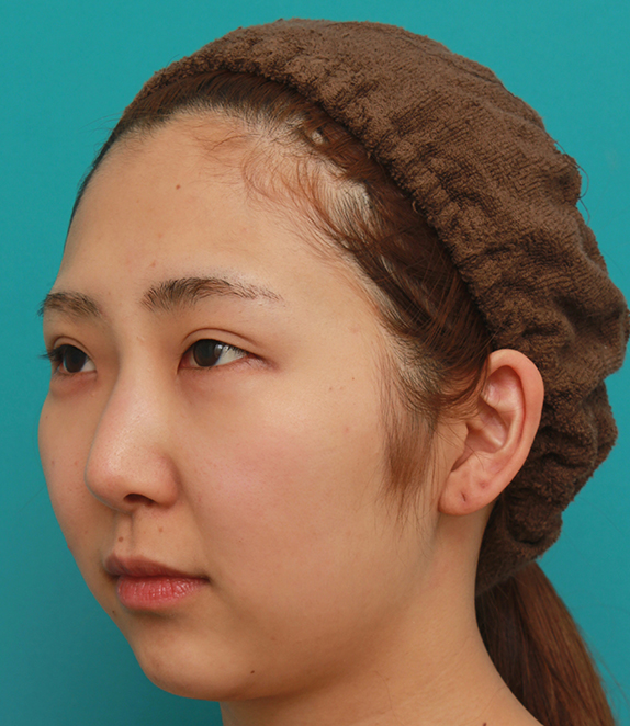 隆鼻注射（ヒアルロン酸注射）,眉間から鼻にかけて長期持続型ヒアルロン酸を注射し、綺麗に鼻筋を通した20代女性の症例写真,Before,ba_ryubichusha55_b.jpg