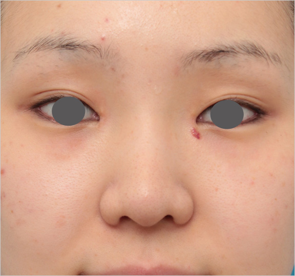 隆鼻術（シリコンプロテーゼ）,鼻シリコンプロテーゼ+鼻先耳介軟骨移植の症例写真の腫れが引いていくダウンタイム経過画像,Before,ba_ryubi79_b.jpg