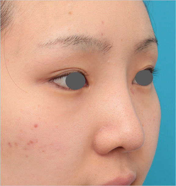 隆鼻術（シリコンプロテーゼ）,鼻シリコンプロテーゼ+鼻先耳介軟骨移植の症例写真の腫れが引いていくダウンタイム経過画像,After（6ヶ月後）,ba_ryubi80_b.jpg