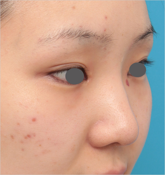 隆鼻術（シリコンプロテーゼ）,鼻シリコンプロテーゼ+鼻先耳介軟骨移植の症例写真の腫れが引いていくダウンタイム経過画像,Before,ba_ryubi80_b.jpg