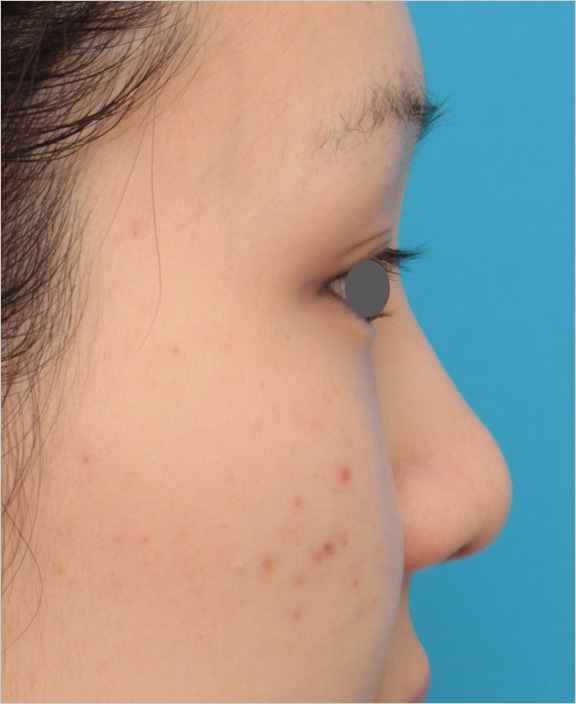 隆鼻術（シリコンプロテーゼ）,鼻シリコンプロテーゼ+鼻先耳介軟骨移植の症例写真の腫れが引いていくダウンタイム経過画像,Before,ba_ryubi81_b.jpg