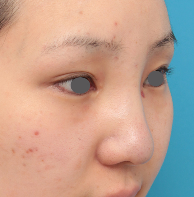 症例写真,鼻シリコンプロテーゼ+鼻先耳介軟骨移植の症例写真の腫れが引いていくダウンタイム経過画像,手術直後,mainpic_ryubi20f.jpg