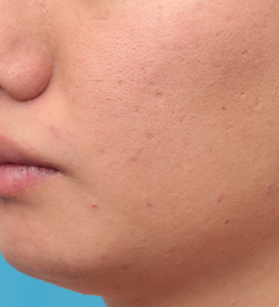 症例写真,頬の黒子をCO2レーザーで分解除去した男性の症例写真の術前術後画像,After（6ヶ月後）,ba_hokuro_ibo_aza27_b.jpg