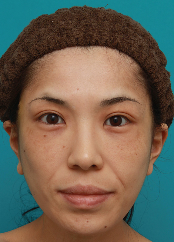 症例写真,ミディアムフェイスリフトで頬のたるみを改善し、法令線が浅くなった30代女性の症例写真,After,ba_mediumlift006_b01.jpg