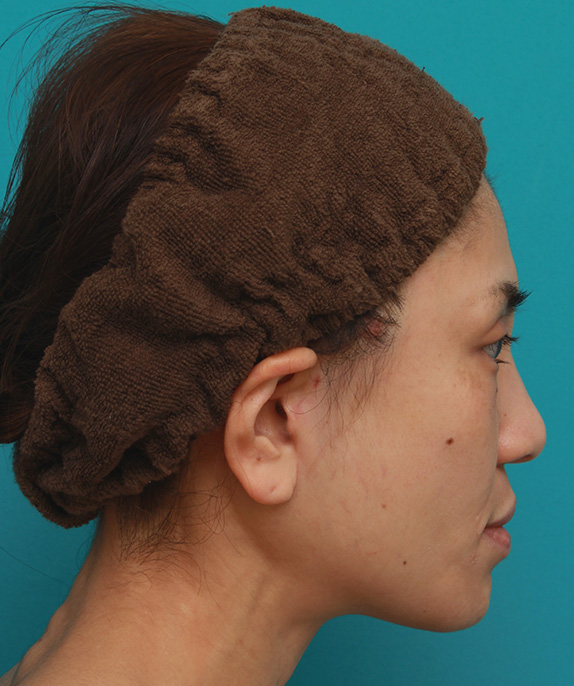 ミディアムフェイスリフト,ミディアムフェイスリフトで頬のたるみを改善し、法令線が浅くなった30代女性の症例写真,After,ba_mediumlift006_b02.jpg