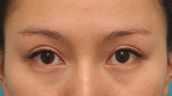 眉下リフト（上眼瞼リフト）,二重まぶたミニ切開法+眉下リフト（上眼瞼リフト）を同時に行った症例写真の術前術後画像,After（6ヶ月後）,ba_jougankenlift009_b01.jpg