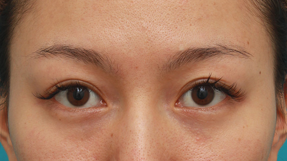 二重まぶたミニ切開法+眉下リフト（上眼瞼リフト）を同時に行った症例写真の術前術後画像,Before,ba_jougankenlift009_b01.jpg