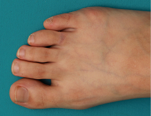症例写真,自分で墨汁で入れた足の指の入れ墨をレーザーで除去した症例写真の術前術後画像,After（4回目レーザー治療後2ヶ月）,ba_irezumi030_b01.jpg