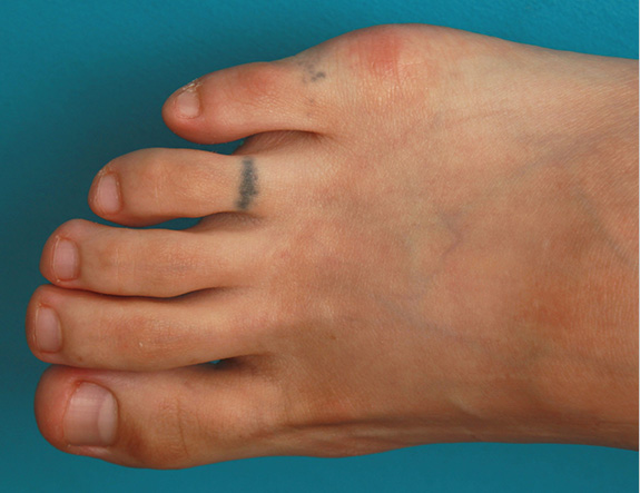 刺青（タトゥー）除去,自分で墨汁で入れた足の指の入れ墨をレーザーで除去した症例写真の術前術後画像,Before,ba_irezumi030_b01.jpg