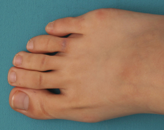 刺青（タトゥー）除去,自分で墨汁で入れた足の指の入れ墨をレーザーで除去した症例写真の術前術後画像,2回目レーザー治療後2ヶ月,mainpic_irezumi030d.jpg