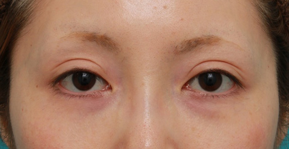 目の下のクマ治療,目の下の脂肪の膨らみを取らず、ヒアルロン酸注射でクマを改善させた症例写真,After（ヒアルロン酸注射後1週間）,ba_kuma016_b01.jpg